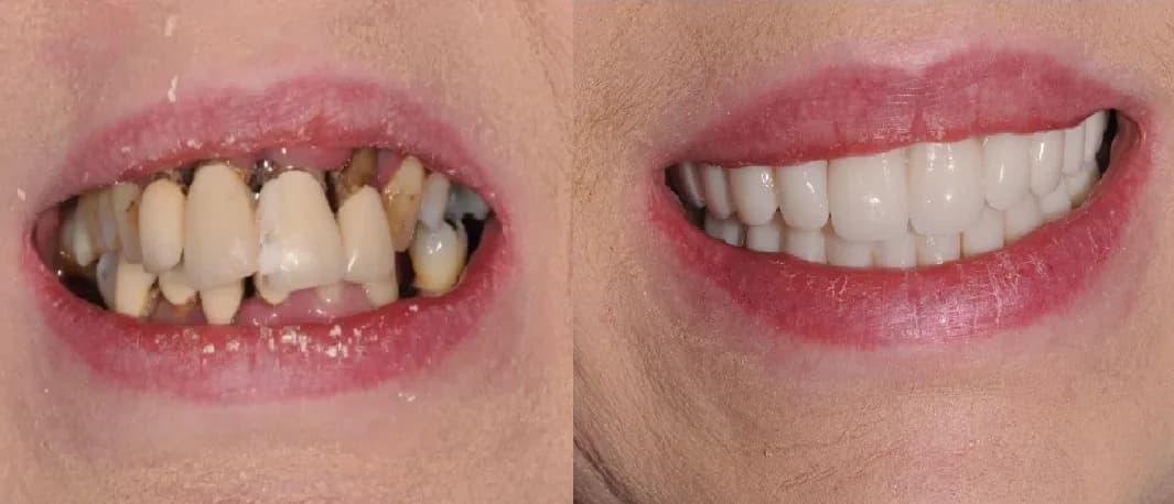Free Full Mouth Implant Consultation Colchester | Love Implants
