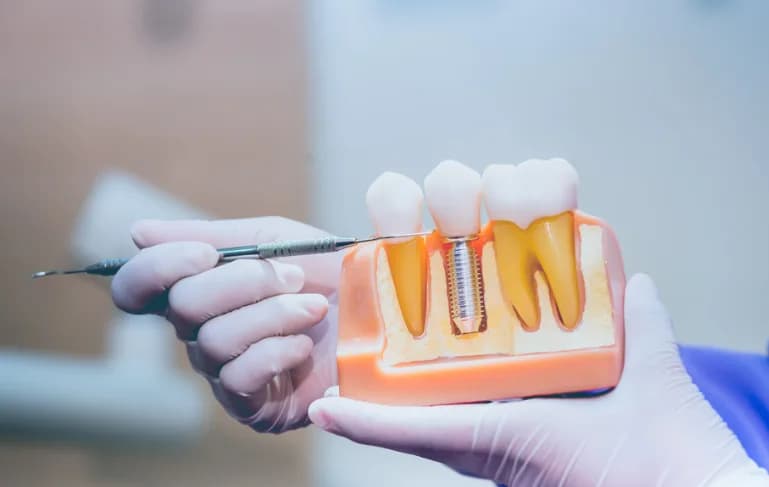 Free Implant Consultation Essex - Love Implants