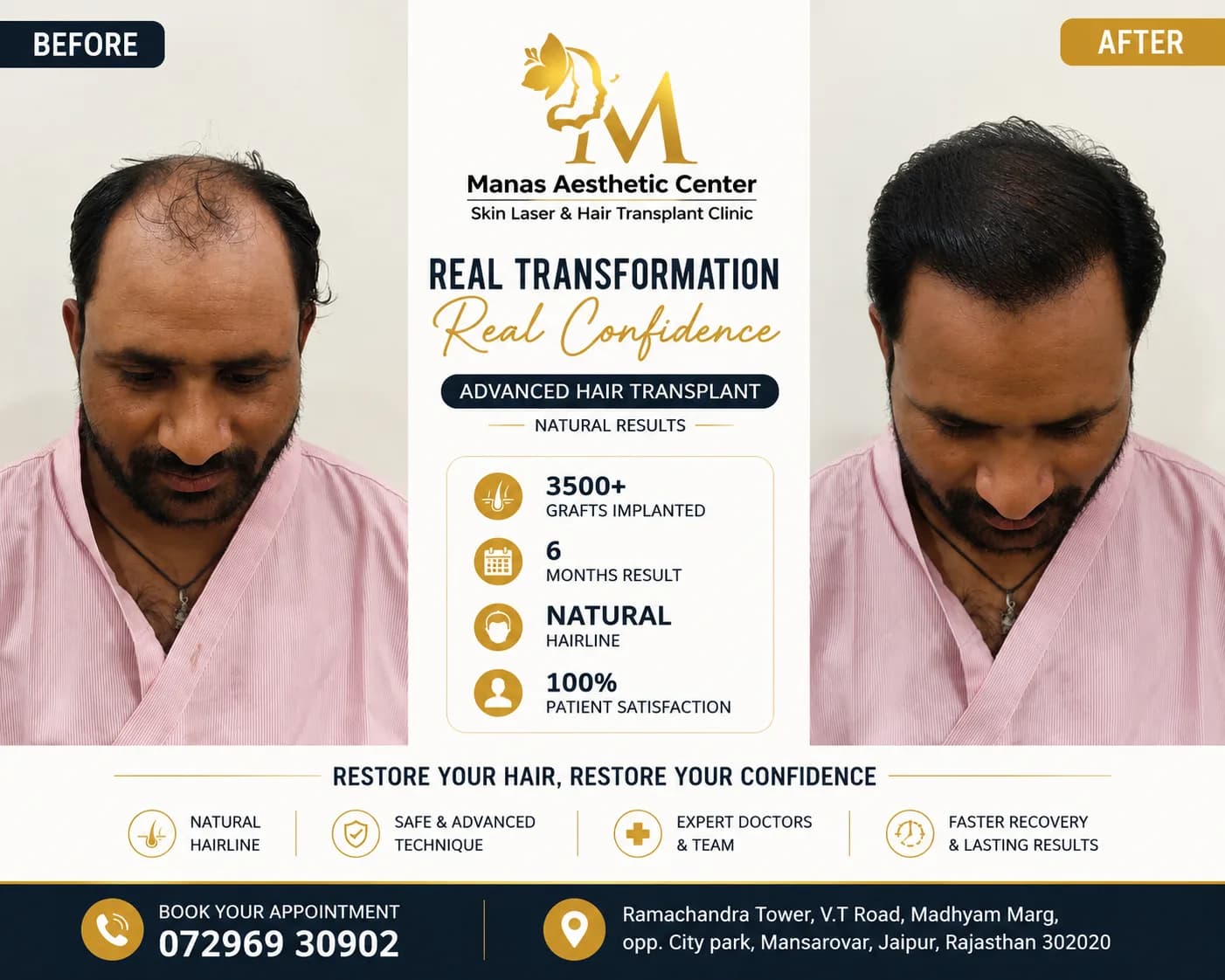 Manas Aesthetic Center hair transplant clinic in jaipur