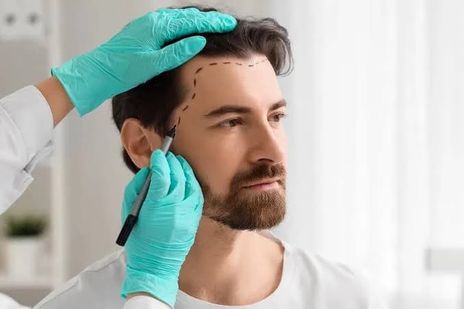 Don't Guess — Consult Best Trichologist in Delhi for Real Hair Loss Solutions 