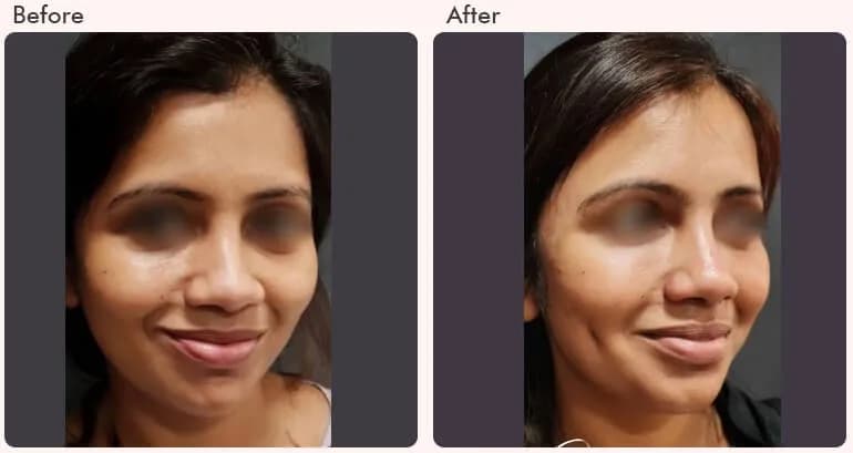 Dimple Creation Surgery Cost in Delhi - Dr Rajat Gupta
