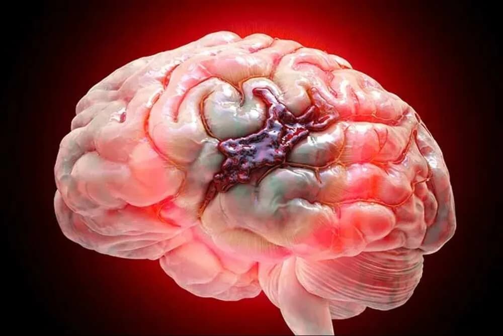 Advanced Solutions for the Treatment of Brain Hemorrhage