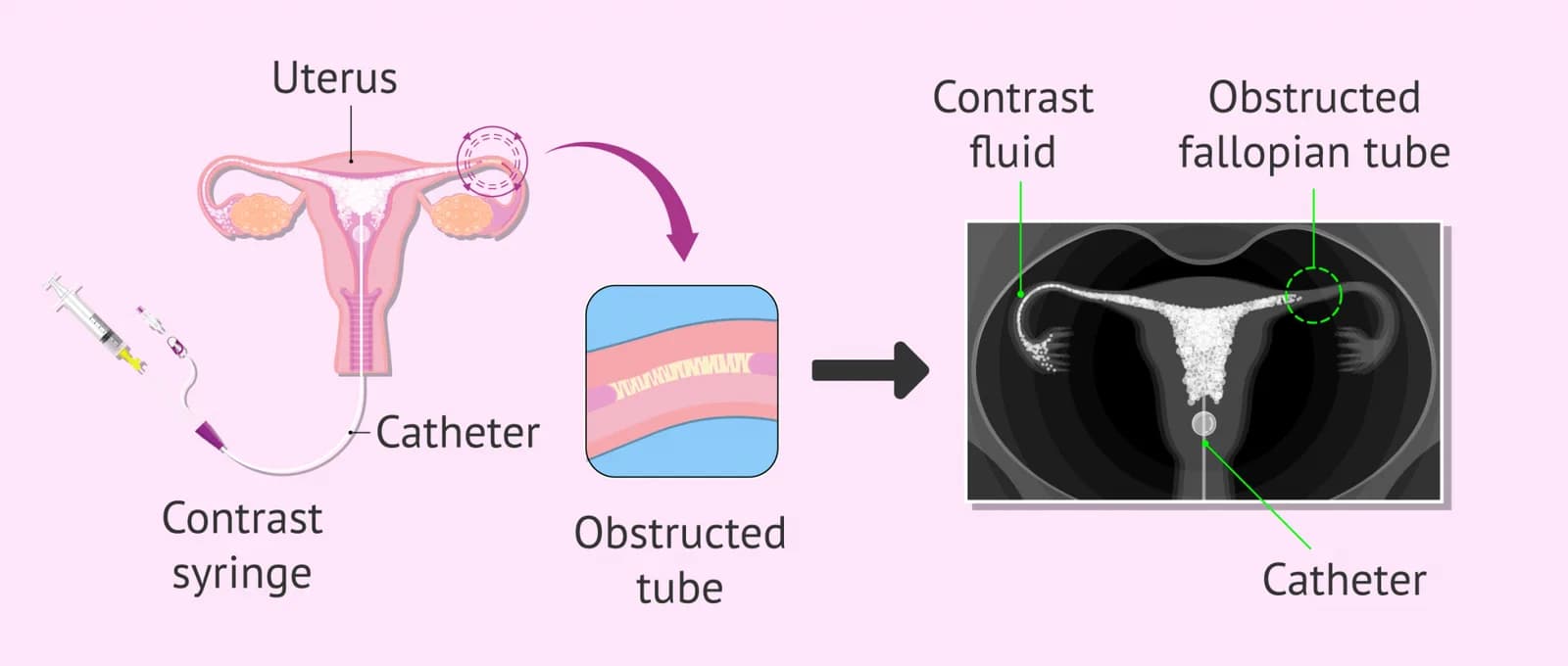 Hysterosalpingography in Delhi – Fertylity IVF Expert Care