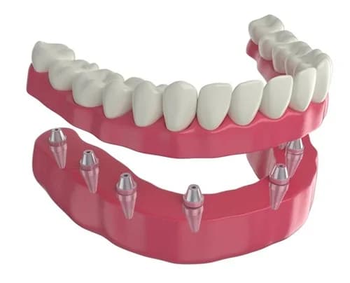 Comfortable Dentures in Bristol PA for a Natural Looking Confident and Healthy Smile