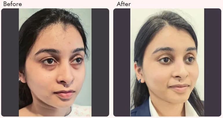 Eyelid Surgery in Delhi - Dr Rajat Gupta 