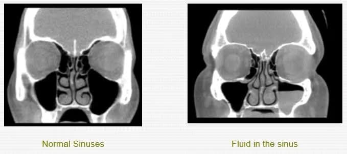 Sinuses pain doctor near me