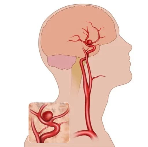 Aneurysm Coiling Procedure | Advanced Minimally Invasive Care