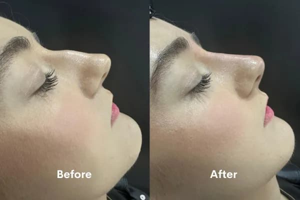 Refine Your Nose Shape in Minutes – Book a Consultation in Chiswick