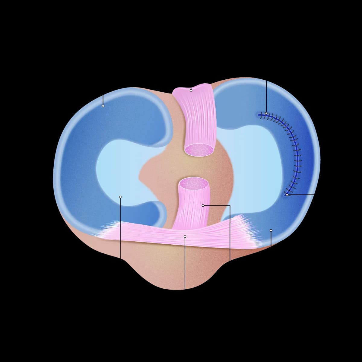 When Is Lateral Meniscus Tear Treatment Needed?  