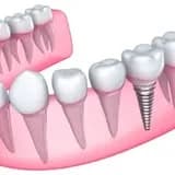 Dental Implants Boca Raton