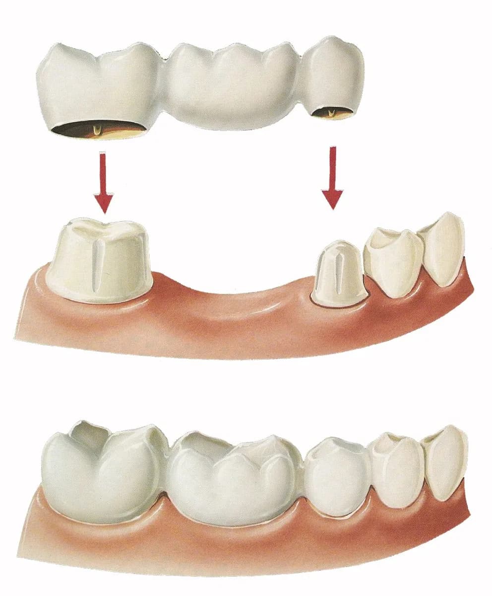 Trusted Brooklyn Dentist | Natural-Looking Crowns & Bridges