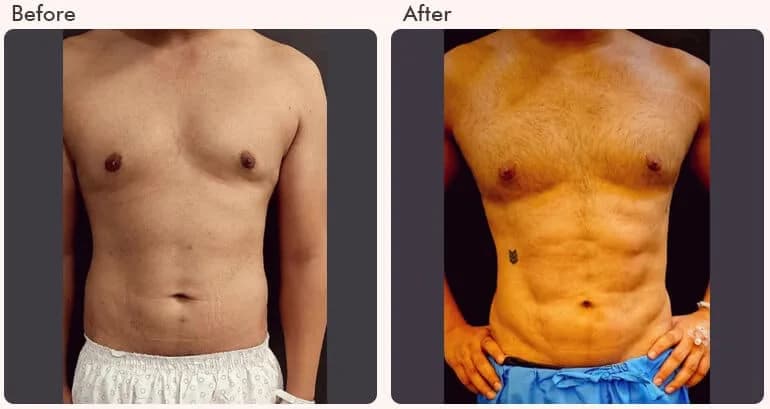 Six Pack Abs Surgery in Delhi - Dr Rajat Gupta
