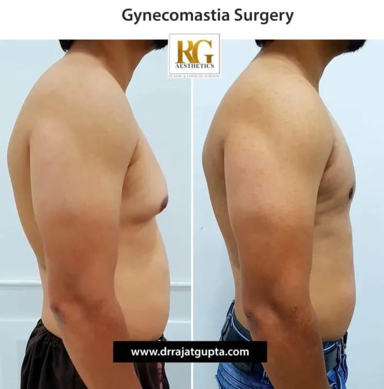 Gynecomastia Before and After: What Results Really Look Like