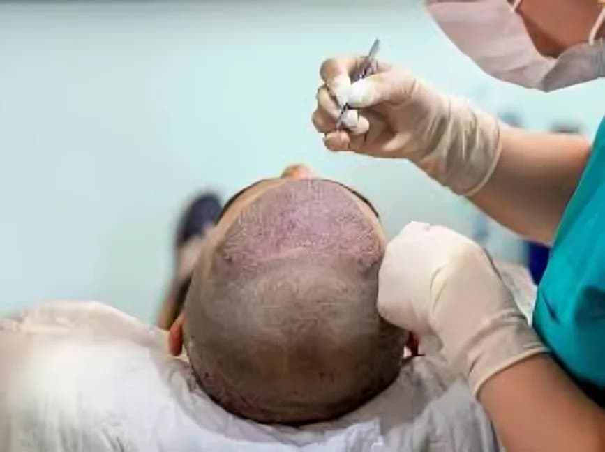 Sydney's Go-To Clinic for Advanced Hair Restoration