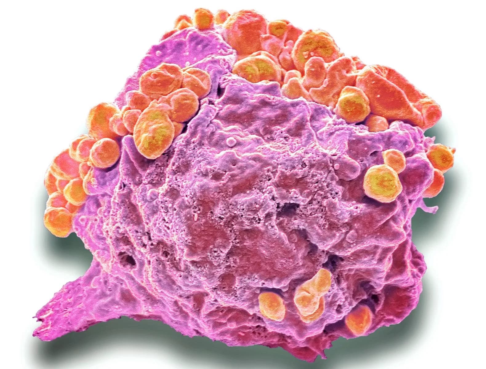  Best Lymphoma and Immunotherapy Cancer Treatment in Noida | Dr. Manish Singhal