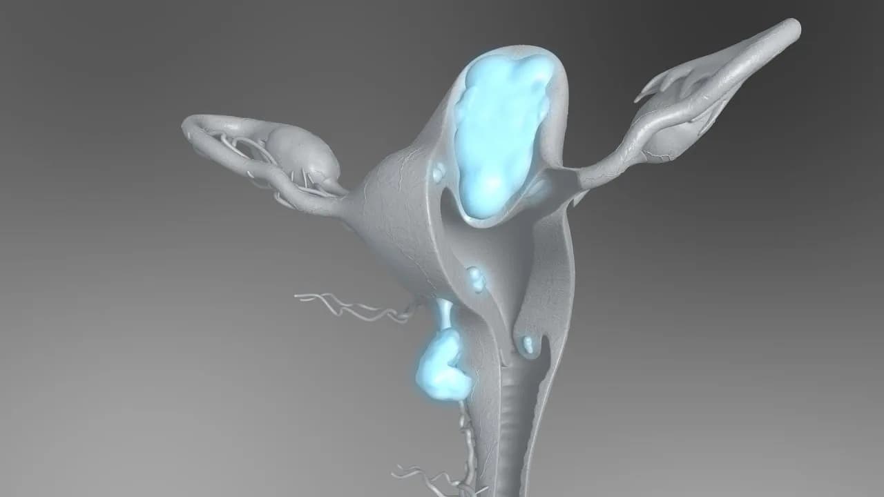 Myomectomy in Delhi for Better Fertility Care | Fertylity IVF
