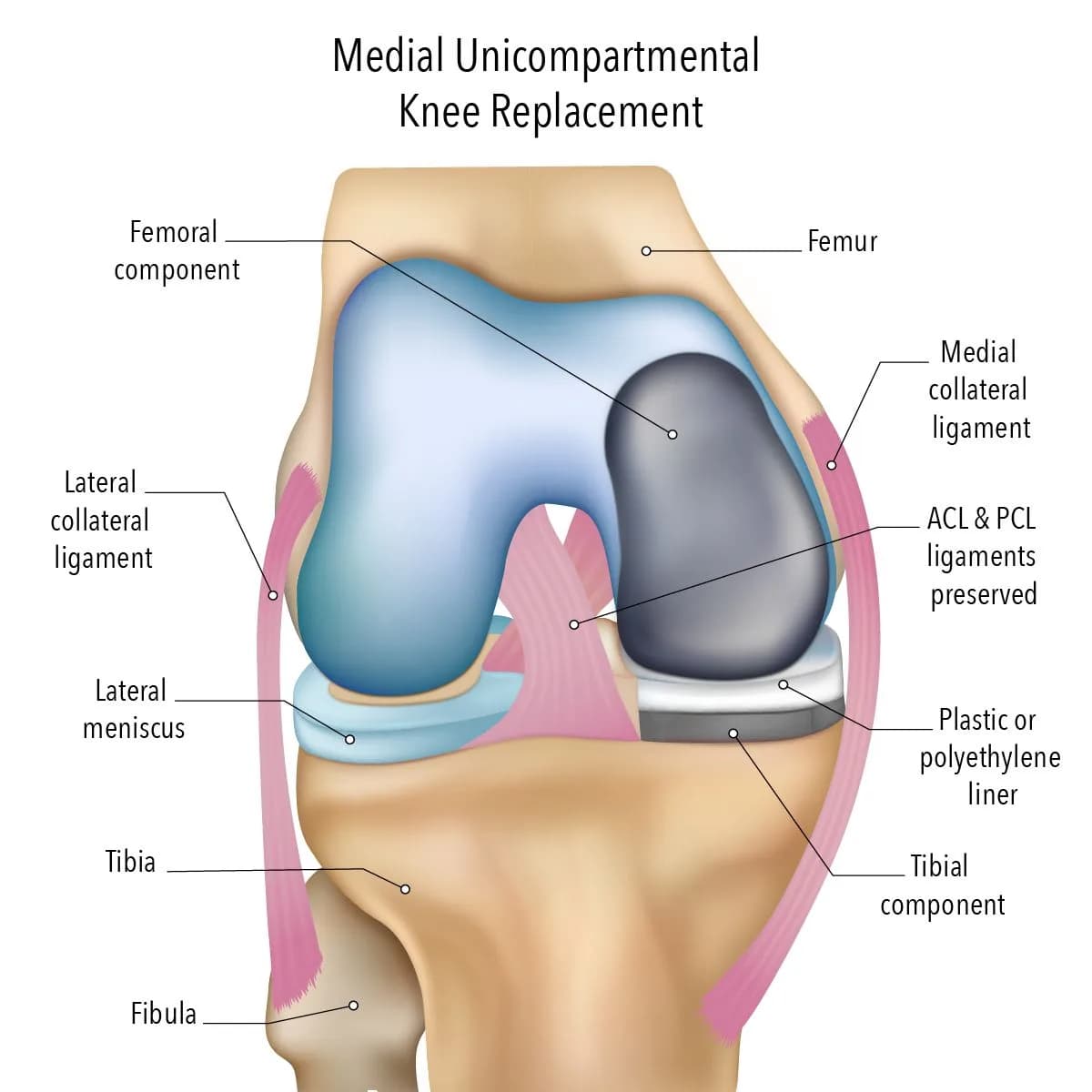 Is Partial Knee Arthroplasty Right for Your Knee?