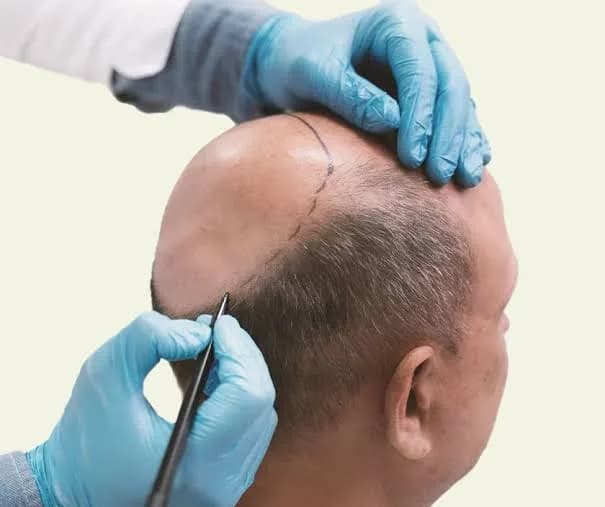 Thin Hair? Not Anymore — India's Most Effective Hair Thinning Treatments