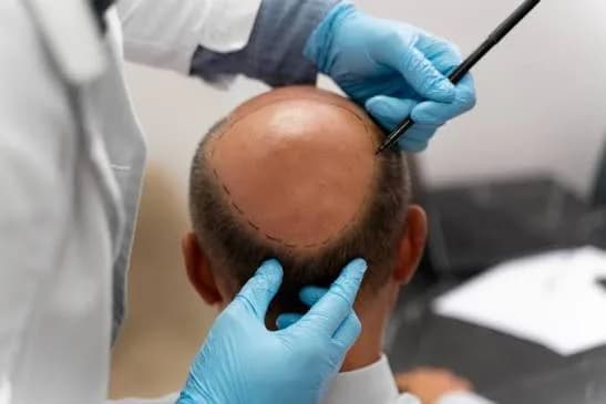 Get Premium Hair Restoration Without Breaking the Bank!