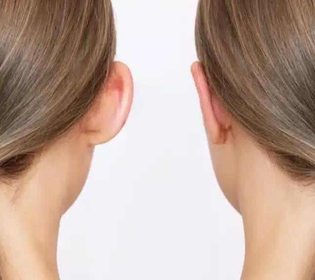 Otoplasty Surgery in Delhi - Dr Rajat Gupta