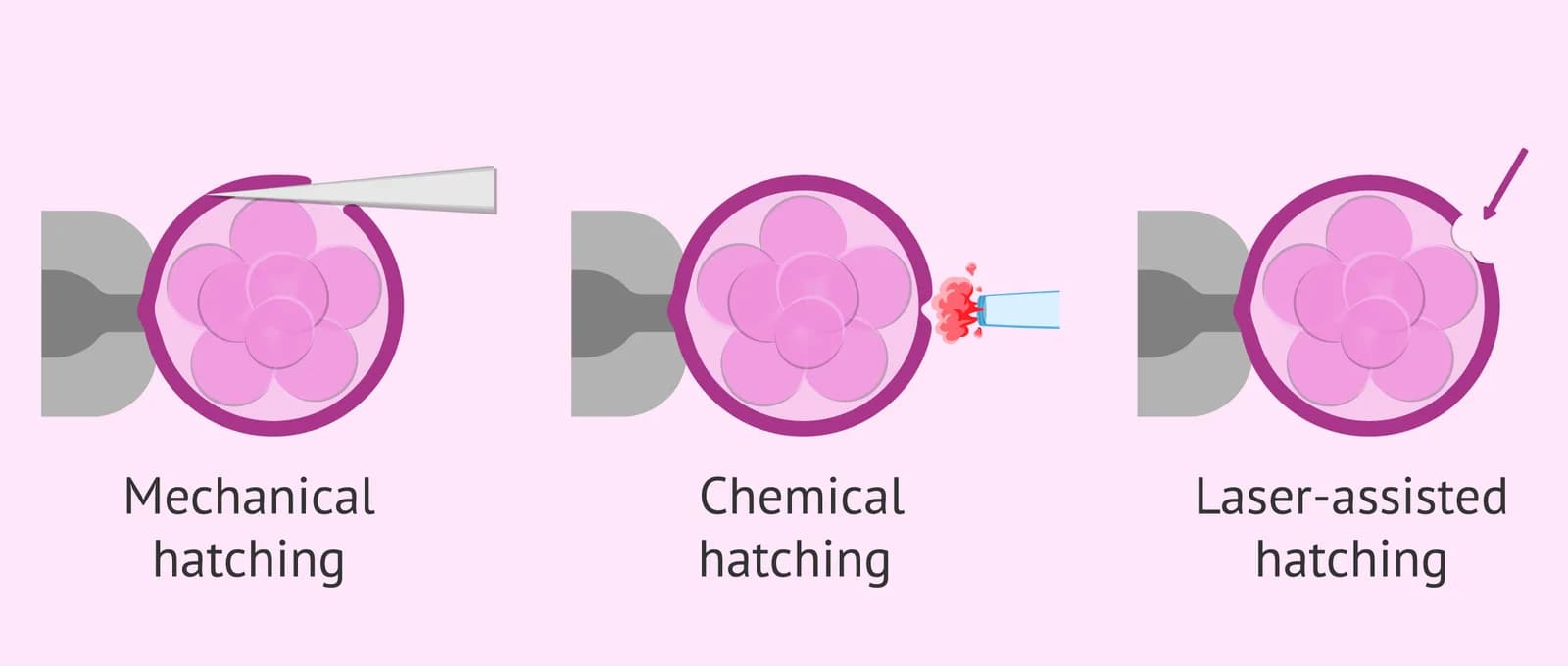 Assisted Embryo Hatching in Delhi for Your IVF Journey | Fertylity ivf