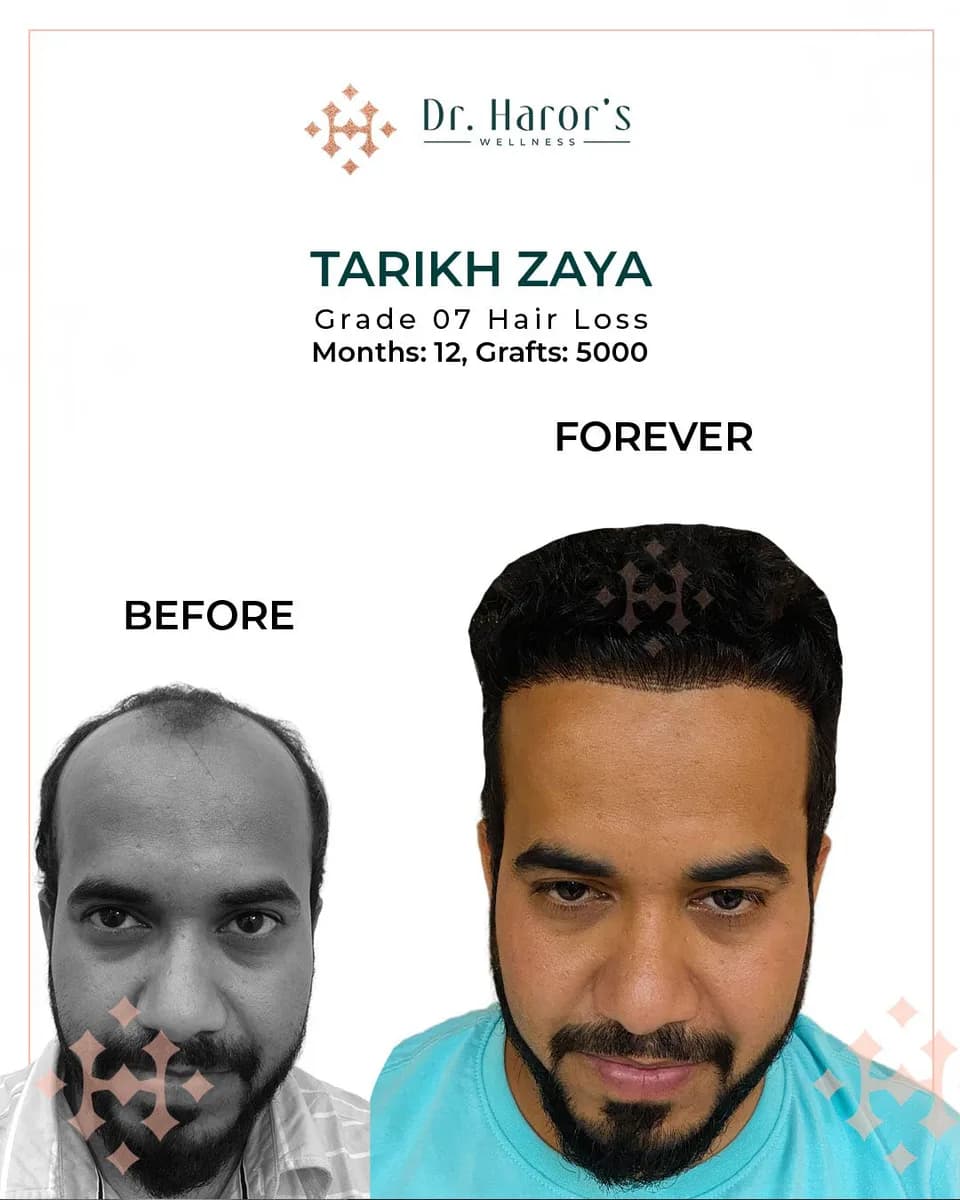  World-Class Hair Transplant, Budget-Friendly Price!