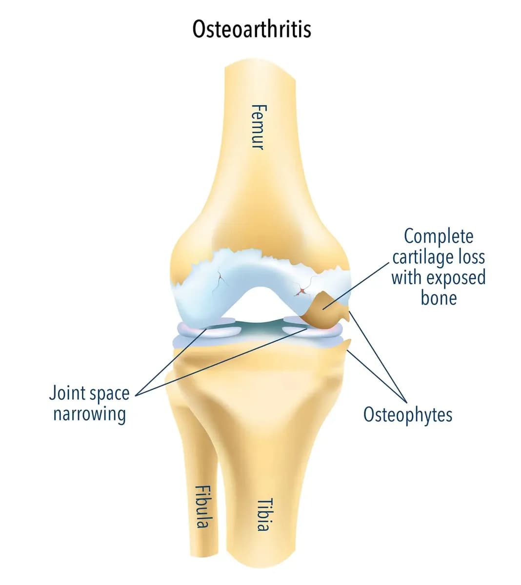 Arthritis Knee Treatment Options Worth Understanding First
