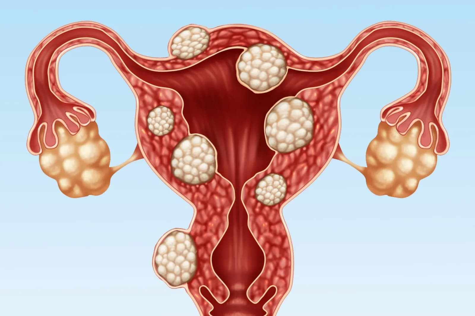 Fibroid Prevention Tips for Better Women’s Health