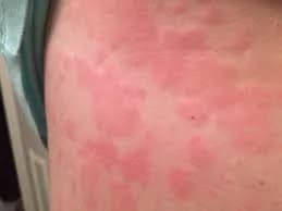 Mast Cell Activation Syndrome