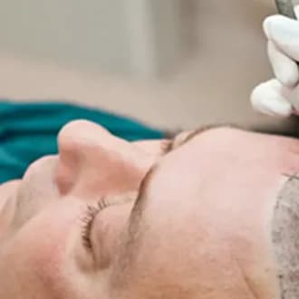  Affordable 5000 Grafts Hair Transplant Cost in Delhi NCR