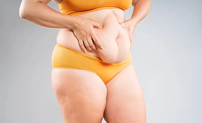 Tummy Tuck Surgery in Delhi - Dr Rajat Gupta