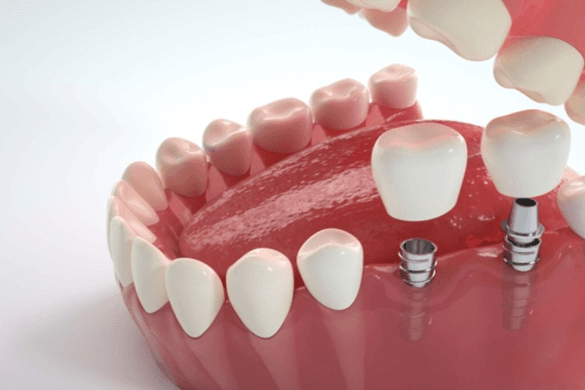 Dental Implants in Northeast Philadelphia for Long Lasting Natural Looking Smiles