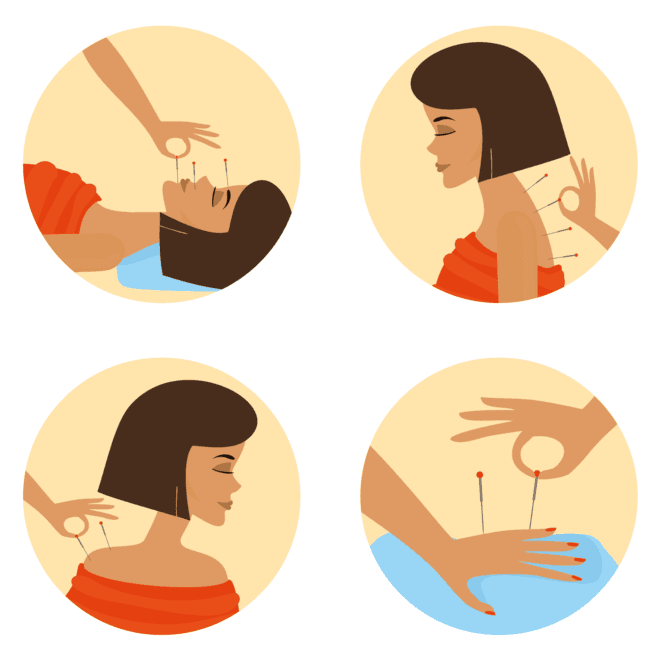 Stayfit Physio Barrhaven Clinic: Acupuncture for Stress & Anxiety