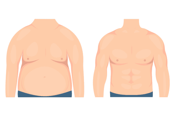 Gynecomastia Treatment in Hyderabad