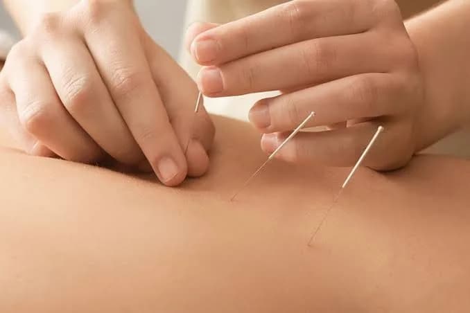 Pain Management Acupuncture in NYC | Back, Neck & Sciatica Relief