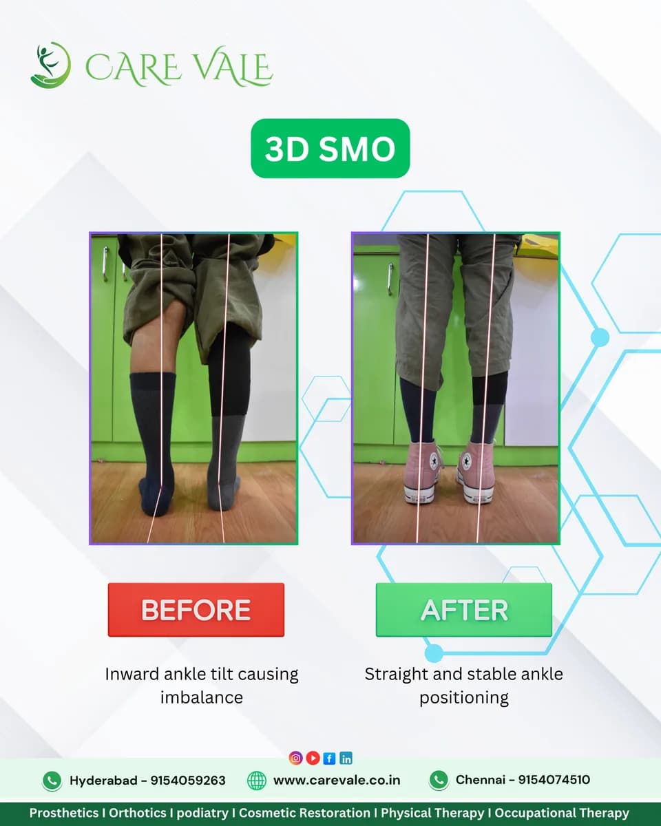 Best Artificial Leg in Hyderabad | CareVale Prosthetics