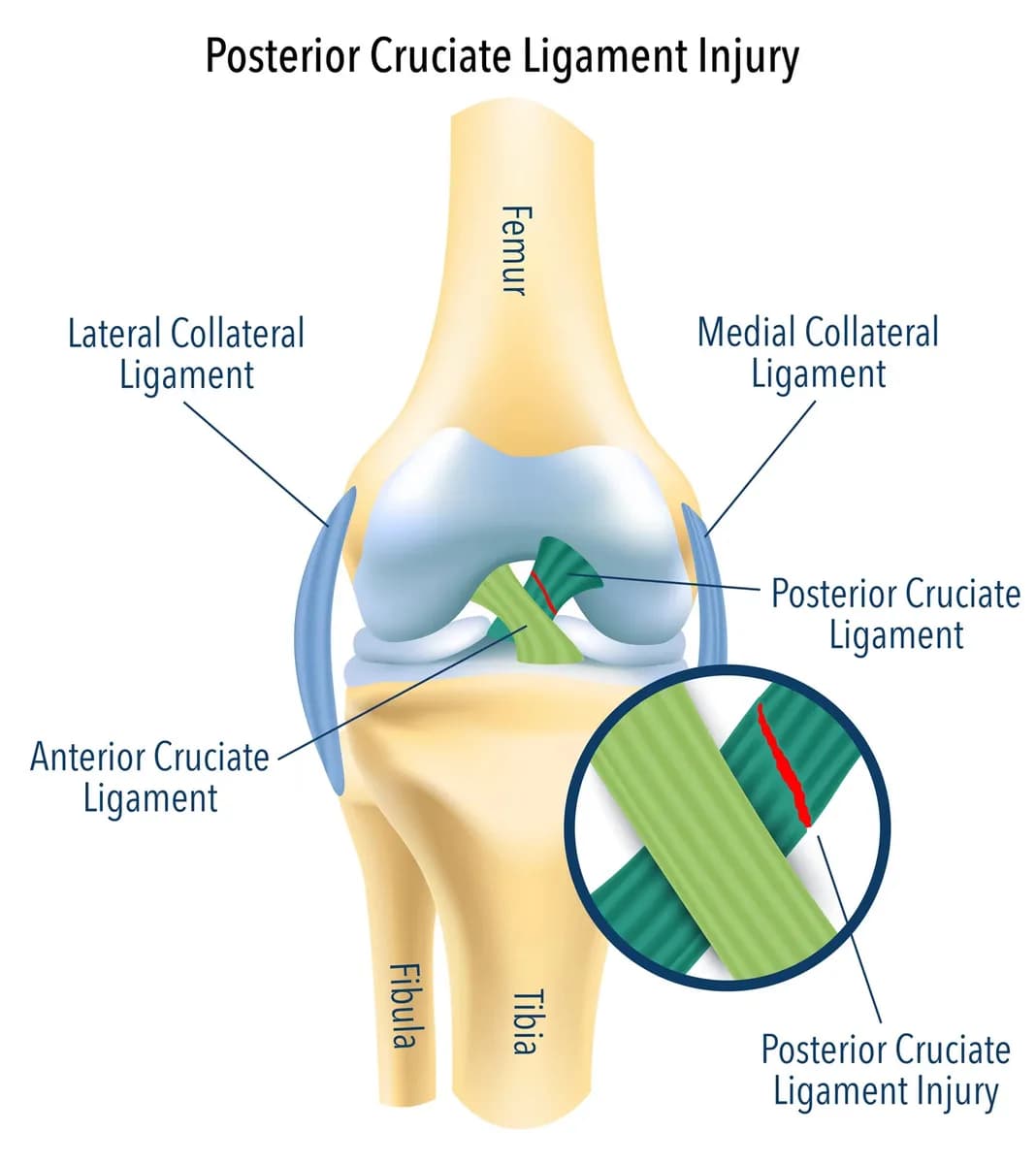 Protect Your Knee from a Posterior Cruciate Ligament Injury