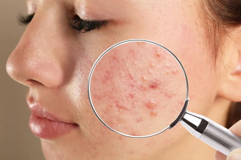 Why Do Acne Marks Become Darker After Picking?