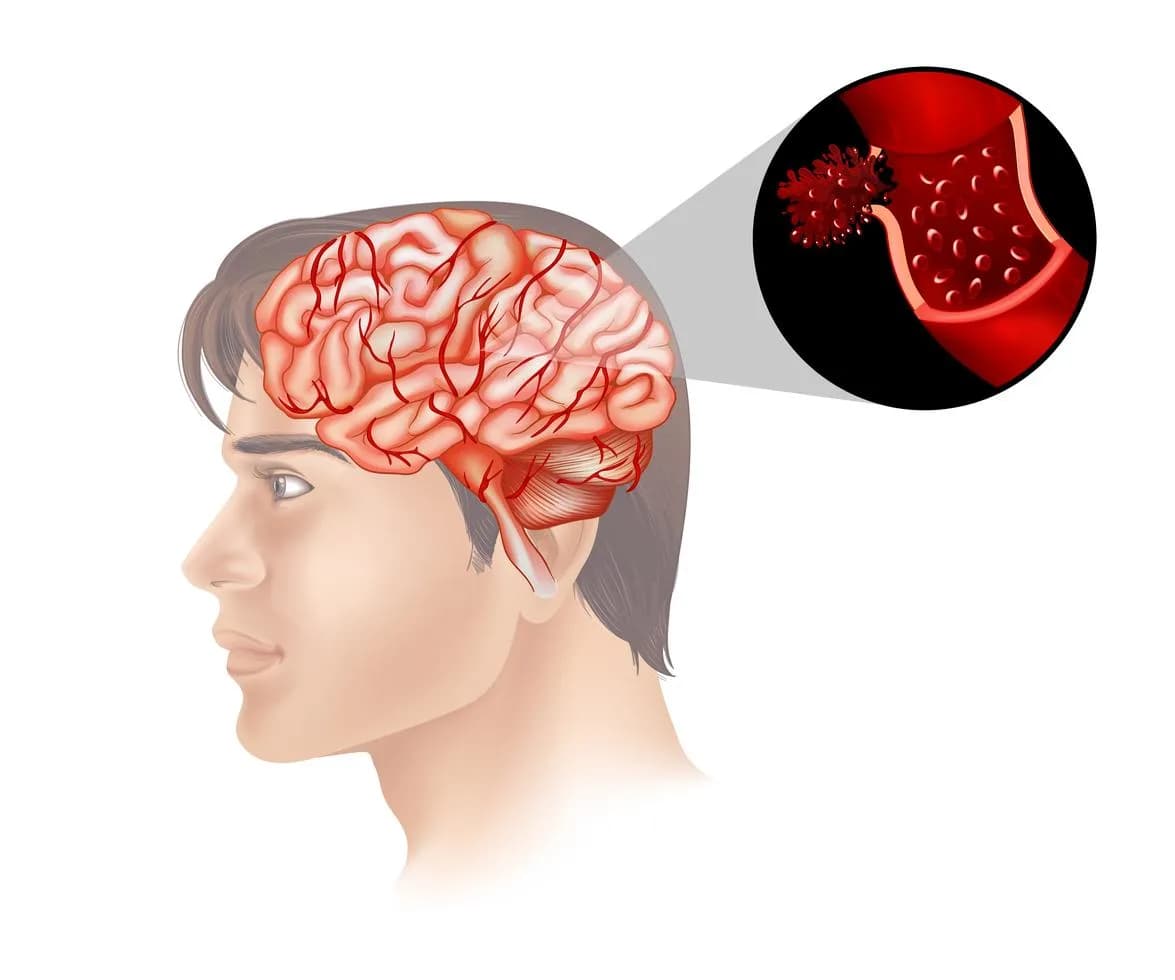 Brain Cancer Diagnosis and Care in Noida | Dr. Manish Singhal