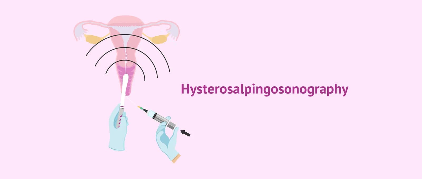 Hysterosalpingography in Delhi | Fertylity IVF Fertility Experts