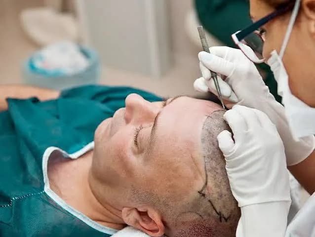 Hair Transplant in India — World-Class Results, Affordable Prices