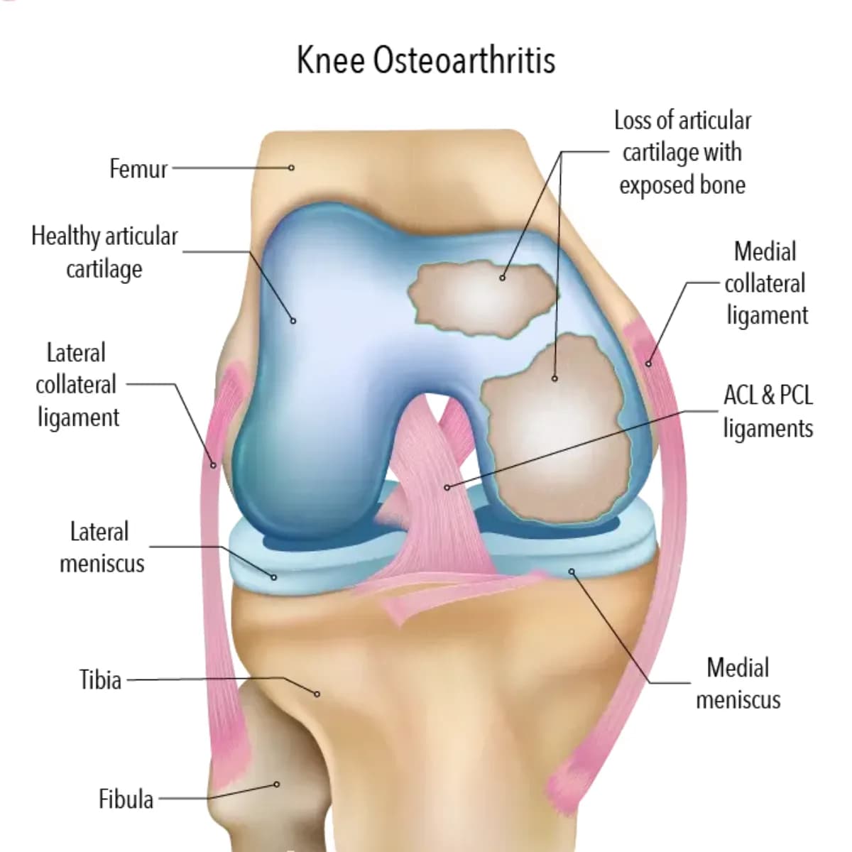 Improve Knee Function with Partial Knee Arthroplasty