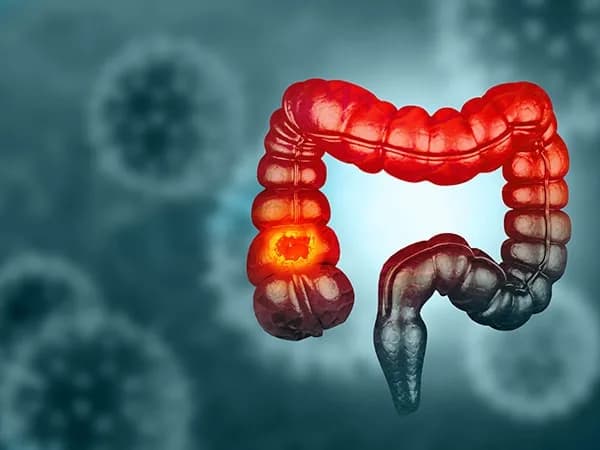 Find Colon Cancer Treatment in Noida with Dr. Manish Singhal