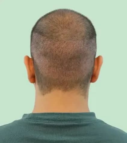 World-class Hair Transplant in Delhi at Dr. Haror’s Wellness