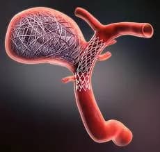 Advanced Aneurysm Coiling Treatment for Safe Brain Care