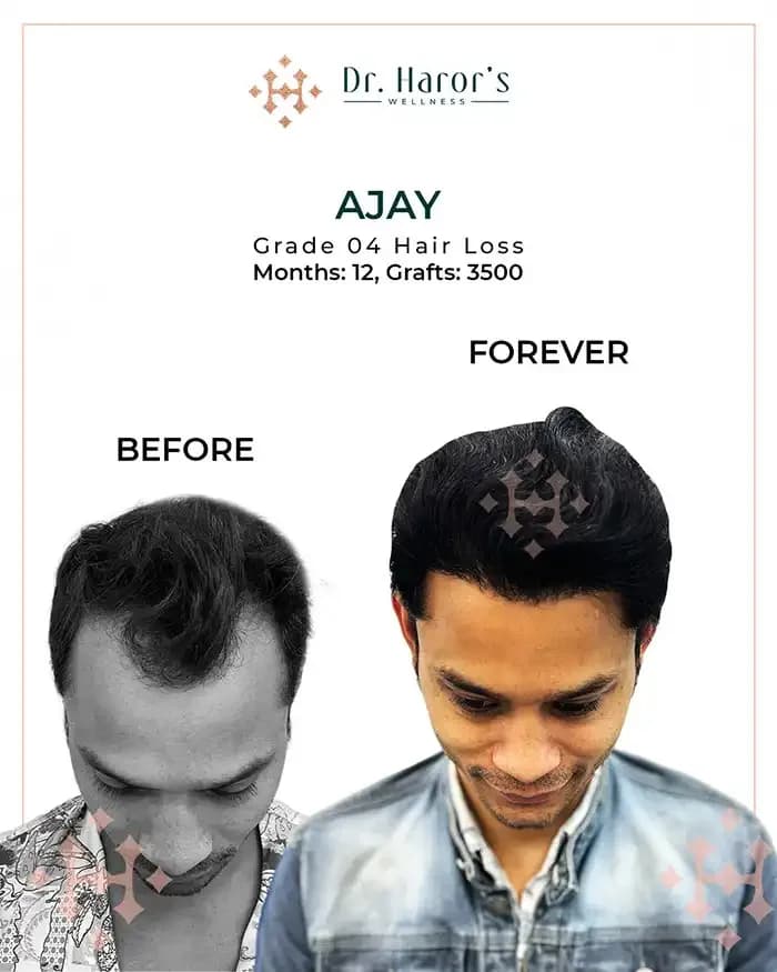 See It to Believe It — Real Hair Transplant Before and After Stories