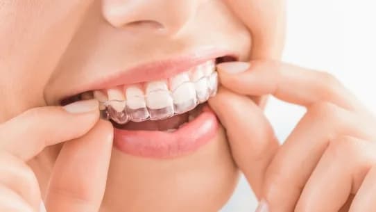 Invisalign Clear Aligners in Marlow for a Straighter Smile Today