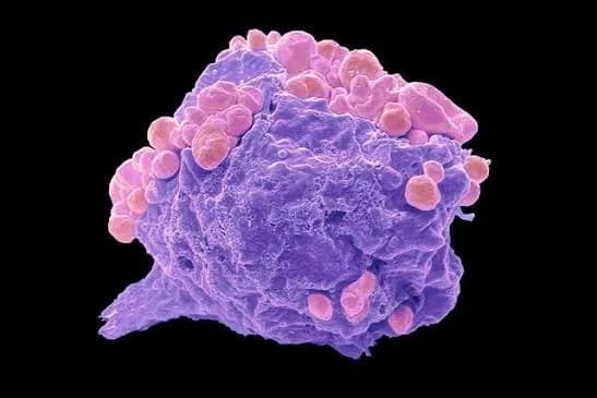Advanced Lymphoma Cancer Treatment in Noida | Cancer Consult